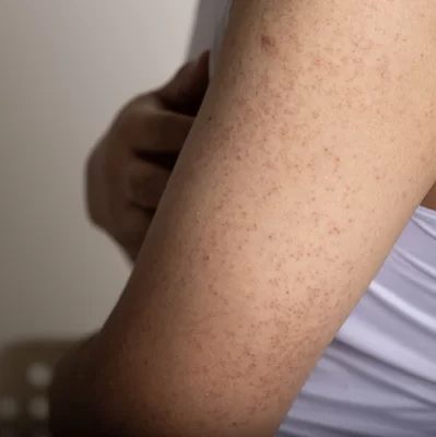 Seborrheic keratosis