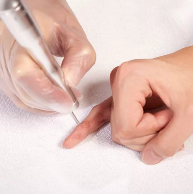 How to get rid of warts?