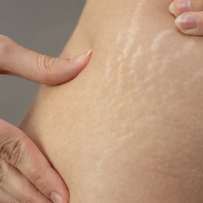 Stretch marks during pregnancy