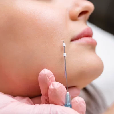 Lifting threads: how long does the effect last?