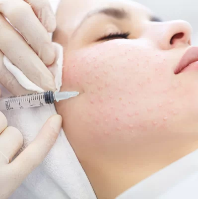 Intradermal mesotherapy: what is it?