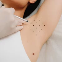 Effective treatment of hyperhidrosis