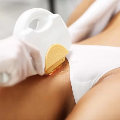 Intimate area hair removal