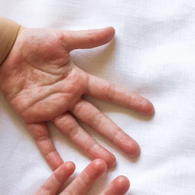 Hand eczema