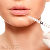 Facts and myths about lip augmentation