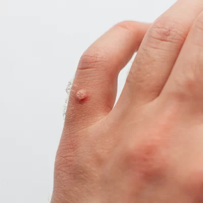 How to get rid of warts?