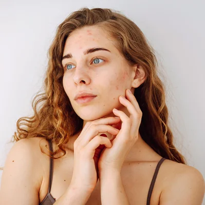 Pimples and breakouts after a seaside vacation - why does the skin rebel after summer?