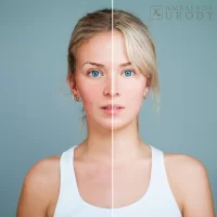 How to effectively remove skin discoloration? Laser treatments