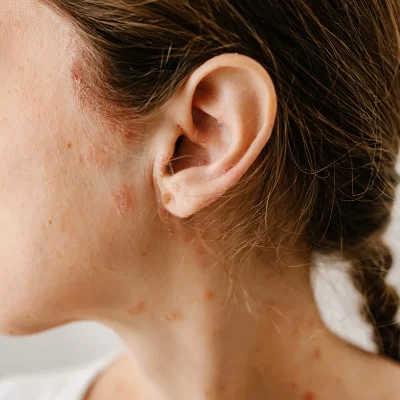 Psoriasis on the face