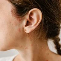 Psoriasis on the face