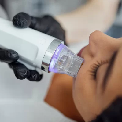 What is nanoneedle mesotherapy?