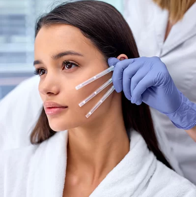 What are PDO threads and how do they work on nasolabial folds?