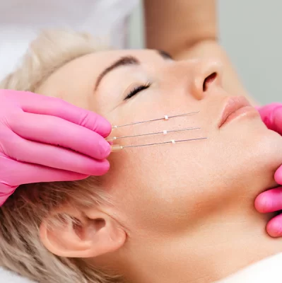 What are PDO threads and how do they work on sagging eyelids?