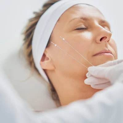 What are PDO threads and how do they work on the chin?