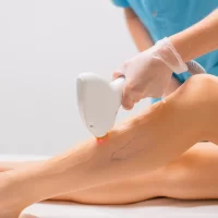 Spider veins on the legs