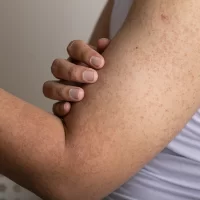 Hornification of the epidermis