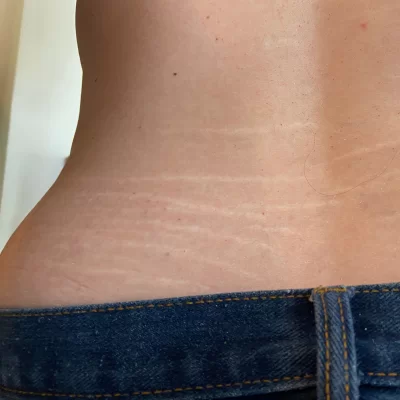 Stretch marks on the back