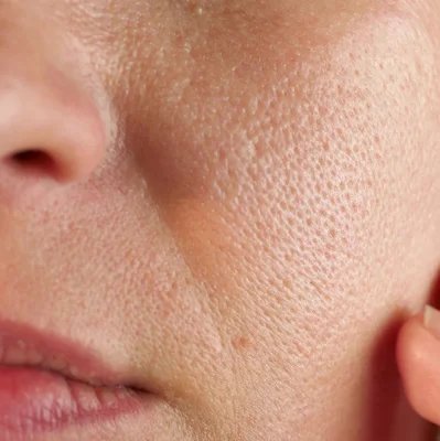 Enlarged pores on the face