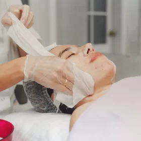 ACIDS PEELS