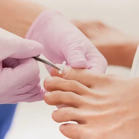 INGROWN TOENAIL CLIPS