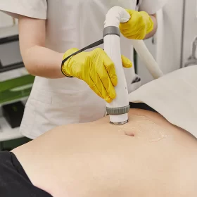 TREATMENTS FOR STRETCH MARKS AFTER PREGNANCY