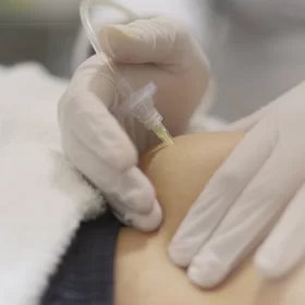 CARBOXYTHERAPY