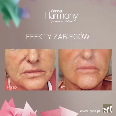 Skin laser resurfacing - ablative fractional laser -20%