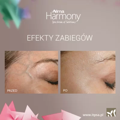 Laser removal of redness and facial veins -20%