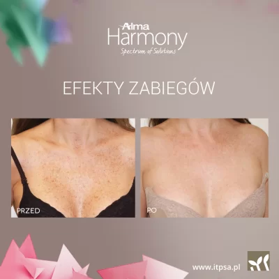 Laser treatment for hyperpigmentation -20%