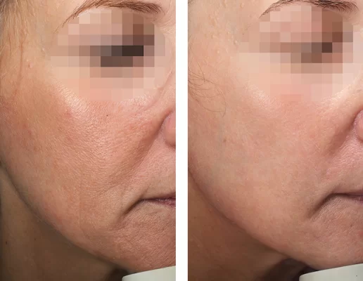 Alma Hybrid hybrid lifting + CO₂ eyelid laser as a gift