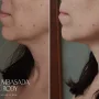 Palomar Medical Deep IR Skin Tightening Laser -20%