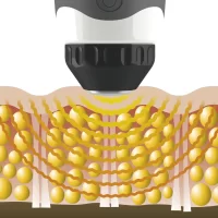 Sound wave package 5 treatments -20%