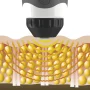 Sound wave package 5 treatments -20%