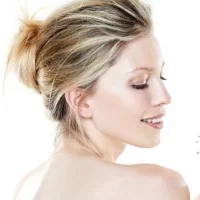 Filling wrinkles and facial contouring with hyaluronic acid -20%