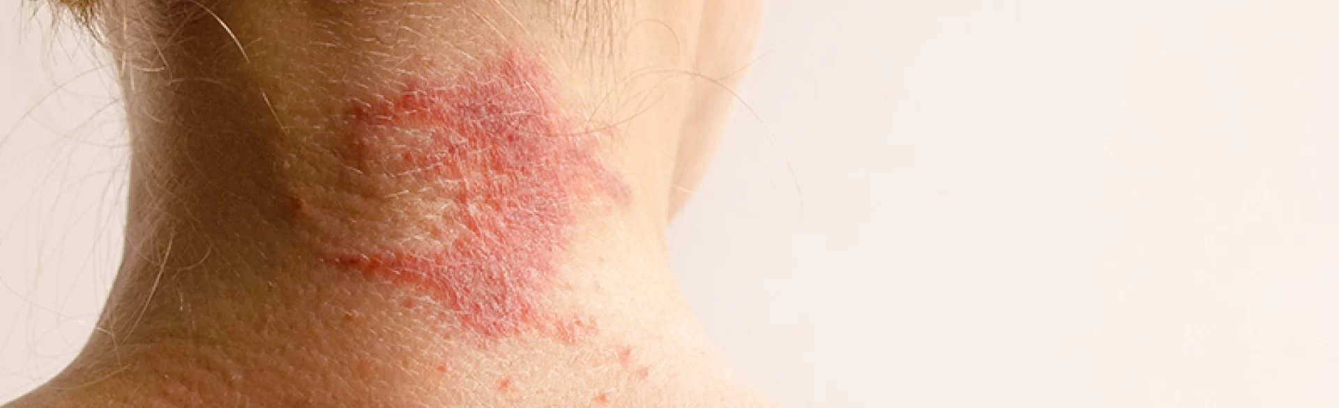 Atopic dermatitis of the scalp