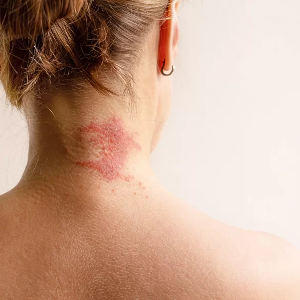 Atopic dermatitis of the scalp