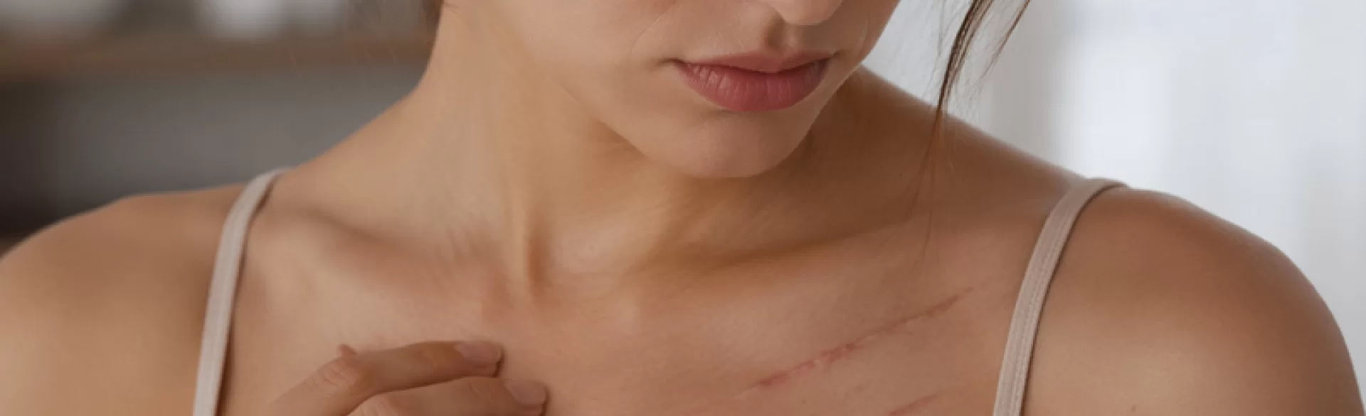 Scars on the cleavage