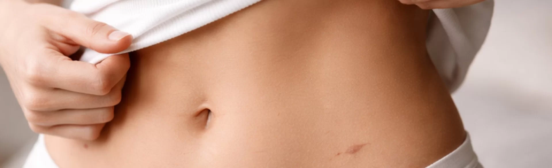 Laparoscopy scars