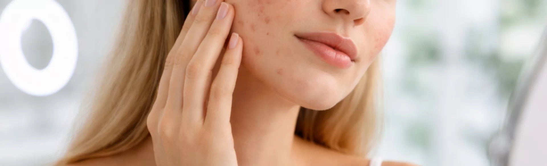 Acne scars