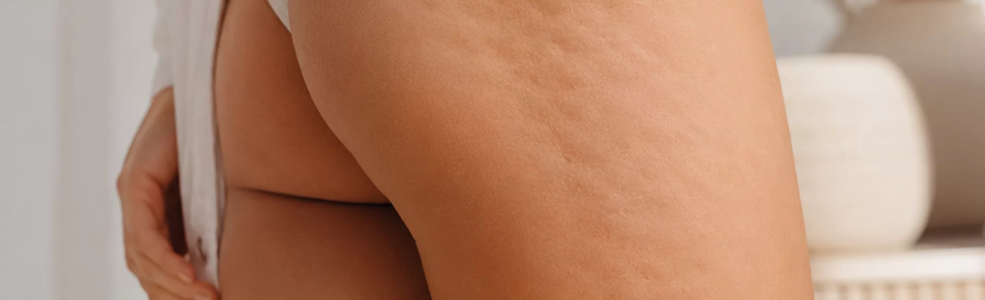 Cellulitis