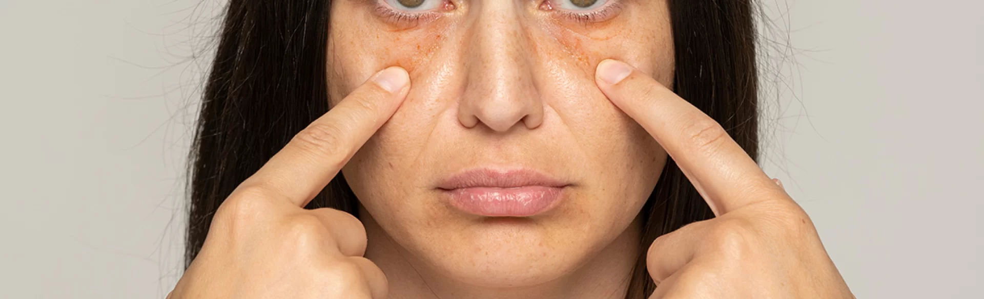 Dark circles under the eyes