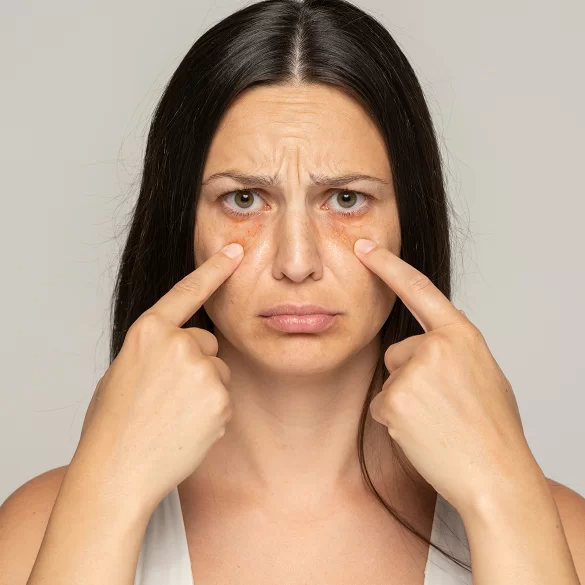 Dark circles under the eyes