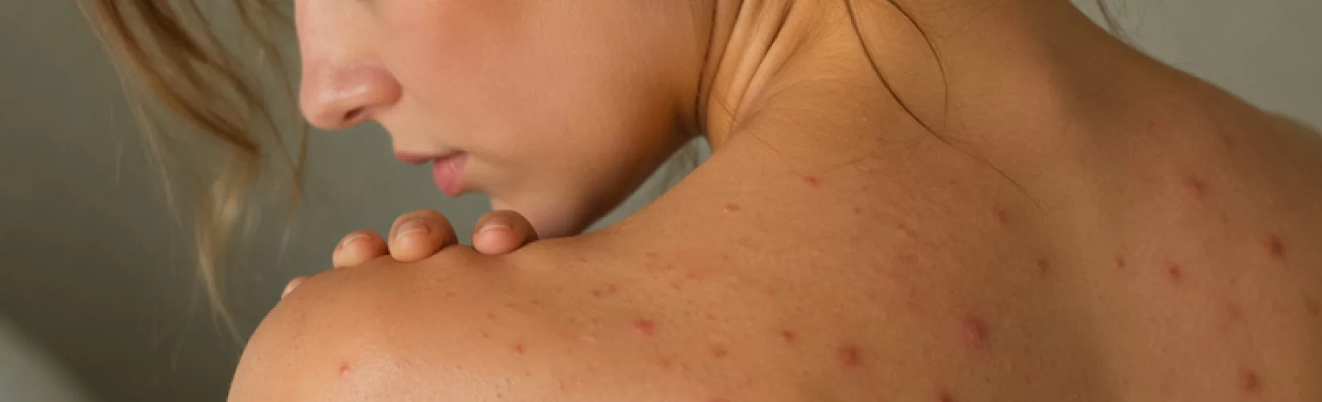 Red pimples on the back