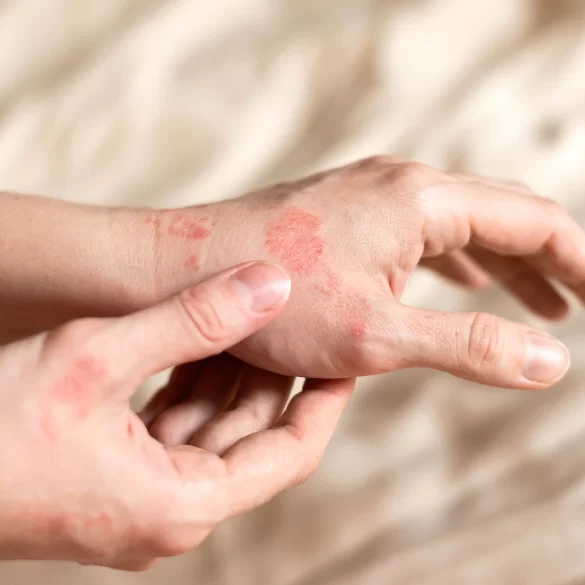 Eczema on the hands