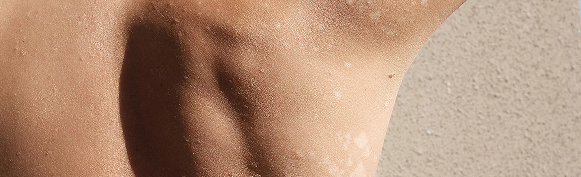 Psoriatic erythroderma