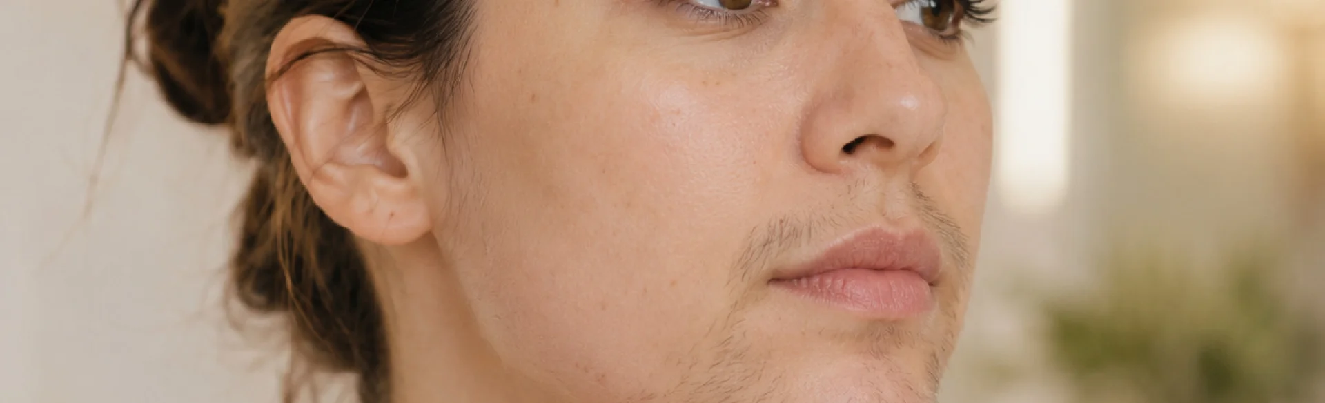 Hirsutism