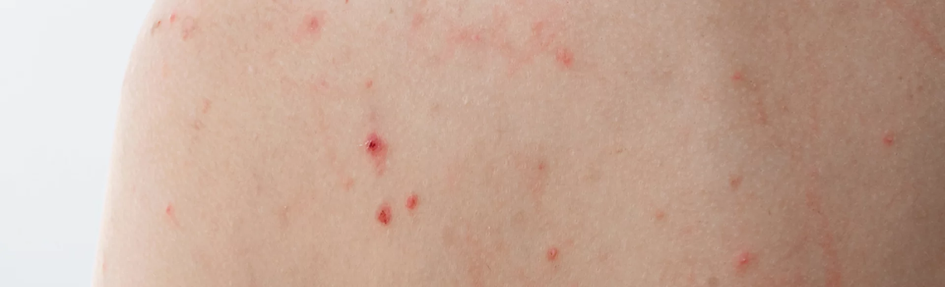 Spots on the back