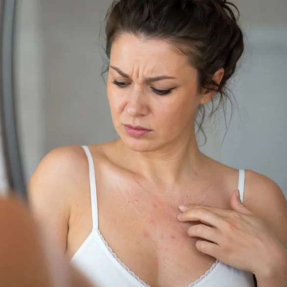 Pimples on the décolletage