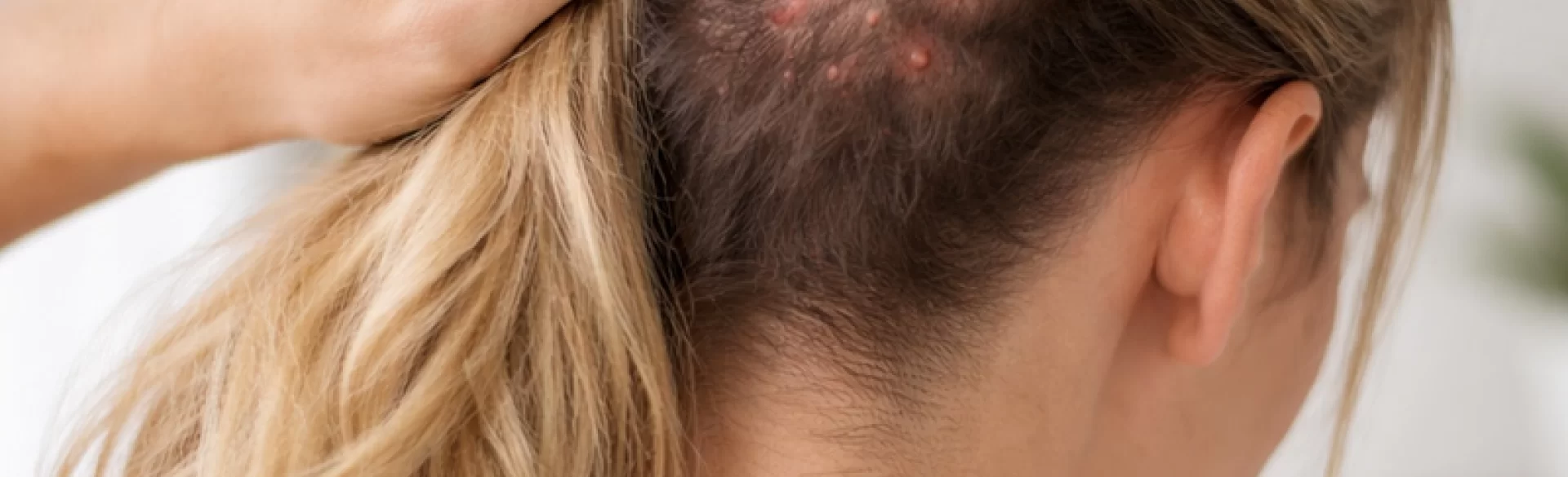 Bumps on the head