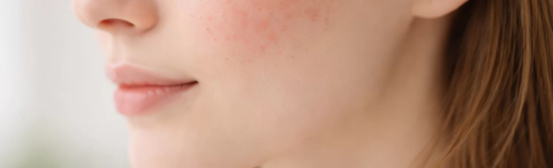 Pimples on the cheeks